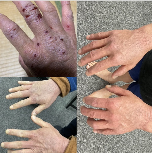 アトピー性皮膚炎 皮膚変化 ビフォーアフター