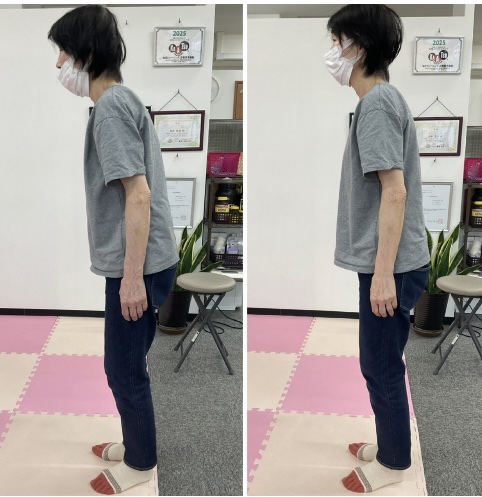 うつ病による前傾姿勢改善 ビフォーアフター