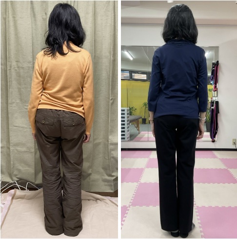 腰椎側湾症改善 ビフォーアフター