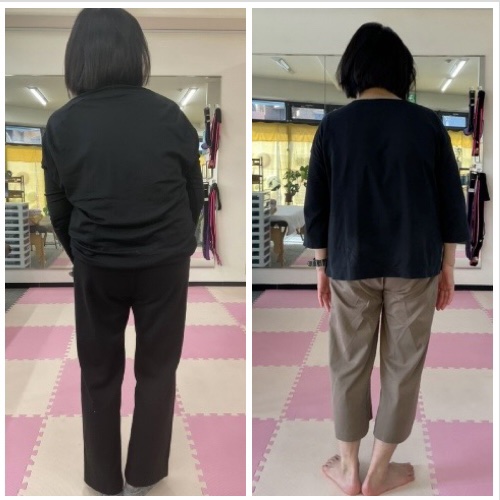 側湾症改善 ビフォーアフター